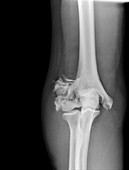 Broken elbow,X-ray