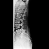 Fractured vertebra,X-ray