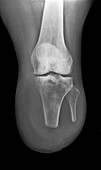 Amputated lower leg,X-ray