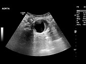 Abdominal aortic aneurysm,ultrasound