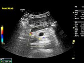 Secondary pancreatic cancer,ultrasound