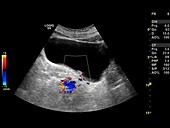 Bladder mass,Doppler ultrasound