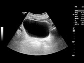Bladder mass,ultrasound scan