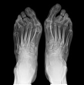 Arthritic feet,X-ray