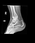 Ankle bone fracture,X-ray