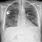 Pacemaker,X-ray