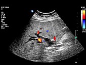 Gallstone,Doppler ultrasound scan