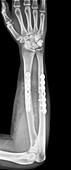 Pinned broken arm,X-ray