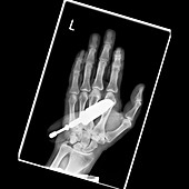 Knife in hand,X-ray