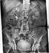 Duplex kidney collecting system,X-ray