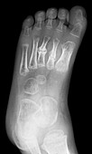 Broken foot,X-ray