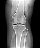 Removed kneecap,X-ray