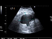 Endometrial cyst,ultrasound scan