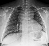 Congenital heart disease,X-ray