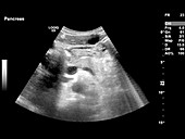 Pancreatic cysts,ultrasound scan