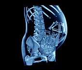 Full term foetus,CT scan