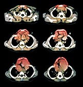 Jeune syndrome,CT scans
