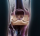 Healthy knee,CT scan