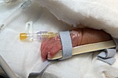 Cannula in neonate's hand