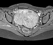 Uterine fibroids,MRI scan