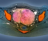 Uterine fibroids,MRI scan