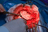 Craniotomy brain surgery
