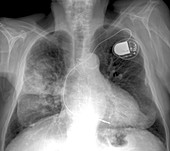 Heart and lung disease,X-ray
