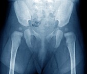 4 month old baby's pelvis,X-ray