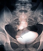 Congenital kidney abnormality,X-ray