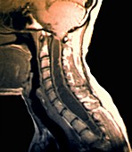 Spinal cord cyst,MRI scan