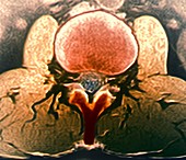 Healthy lumbar spine,MRI
