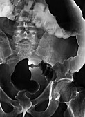 Colon cancer,barium X-ray