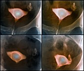 Endometrial polyp,X-rays