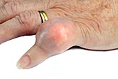 Gout tophus on finger