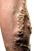 Varicose veins