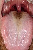 Black hairy tongue
