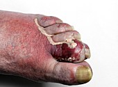 Ulcerated gout