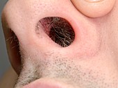 Perforated nasal septum