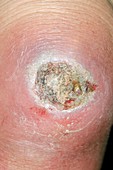 Infected knee graze