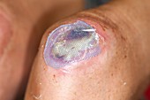 Infected knee ulcer