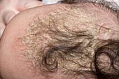 Cradle cap