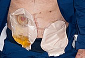 Ostomy bags following cancer treatment