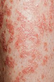 Psoriasis