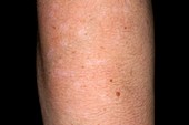 Depigmentation of skin in psoriasis