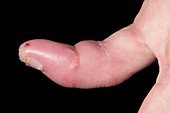 Reconnected amputated finger