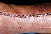 Surgical wound on broken leg