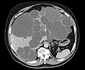 Polycystic liver disease,CT scan