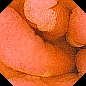 Gastric metaplasia,pill camera view