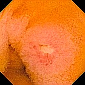 Crohn's disease ulcer,pill camera view