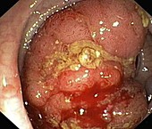 Colon adenoma,endoscope view